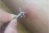 GIÁM SÁT CA BỆNH NHIỄM GIUN RỒNG TẠI THÀNH PHỐ HÒA BÌNH